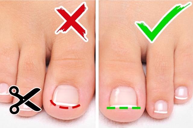 脚趾甲长到肉里一招解决方法贴吧,运动后脚趾甲肿了怎么快速消肿