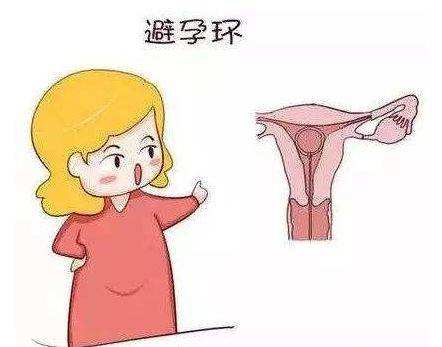 女性上环解析,女性上环那些事儿你都了解么