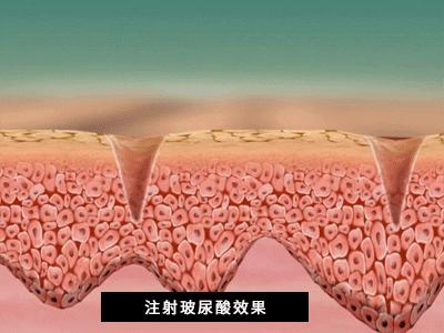 玻尿酸补水保湿效果好吗,玻尿酸保湿效果如何