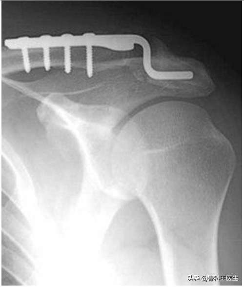 武磊肩锁关节脱位怎么治疗,武磊肩部受伤