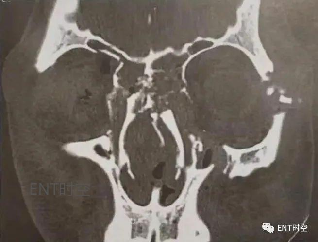 医学影像学解剖鼻骨,医学影像骨折
