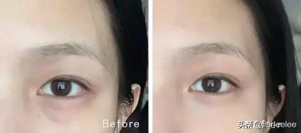 眼角皱纹最显老要注意防晒,眼角皱纹去皱最有效的方法