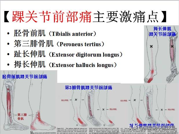 激痛点挂图,激痛点疗法笔记