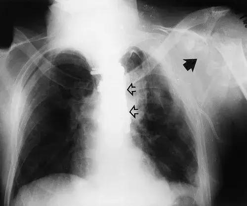 神经性骨关节病,神经性关节炎症状图片