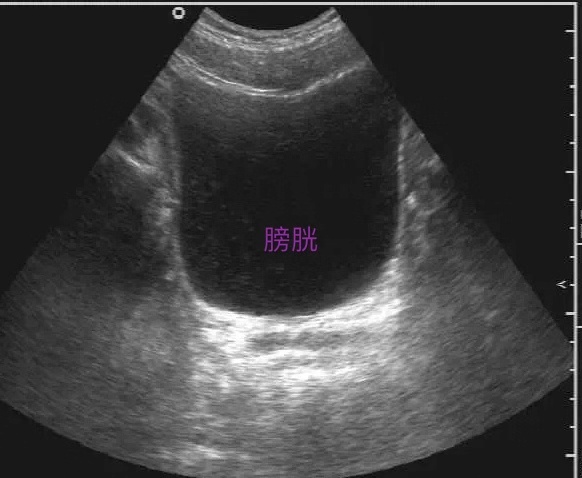 超声检查膀胱没事还要做膀胱镜吗,做彩超憋尿对膀胱有危害吗