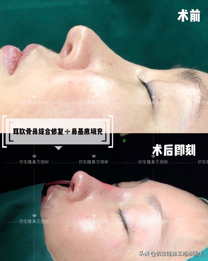 整形鼻部科普知识,隆鼻整形科普知识