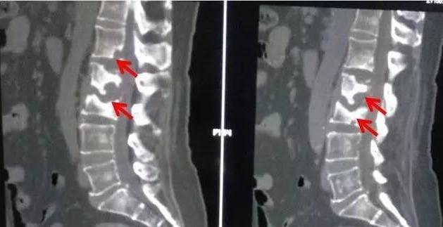结核通俗讲什么意思,结核概述
