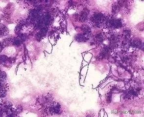 猪链球菌感染病例诊断及防治