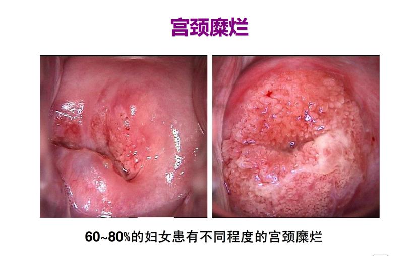 71岁女性筛查hpv高危是不是宫颈癌,男性hpv和哪些癌症有关