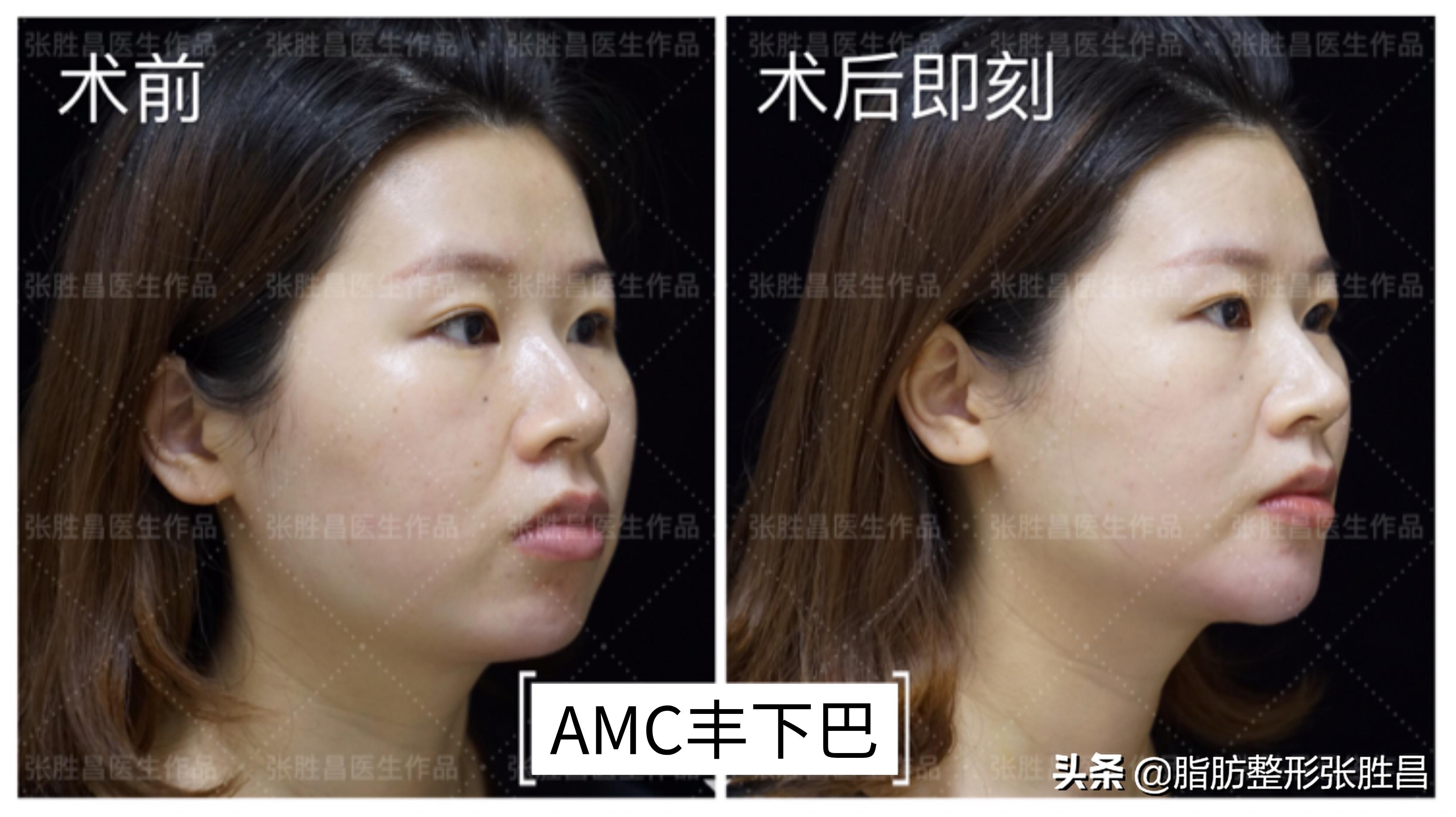 后缩的下巴打玻尿酸效果会好吗,下巴后缩打玻尿酸有效果吗