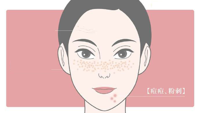 果酸换肤对哪种痘坑有效,果酸换肤对脂肪粒有效吗