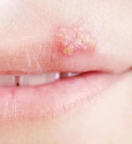 嘴唇反复起泡发炎是什么情况,嘴唇红肿起泡有灼烧感周围一圈红