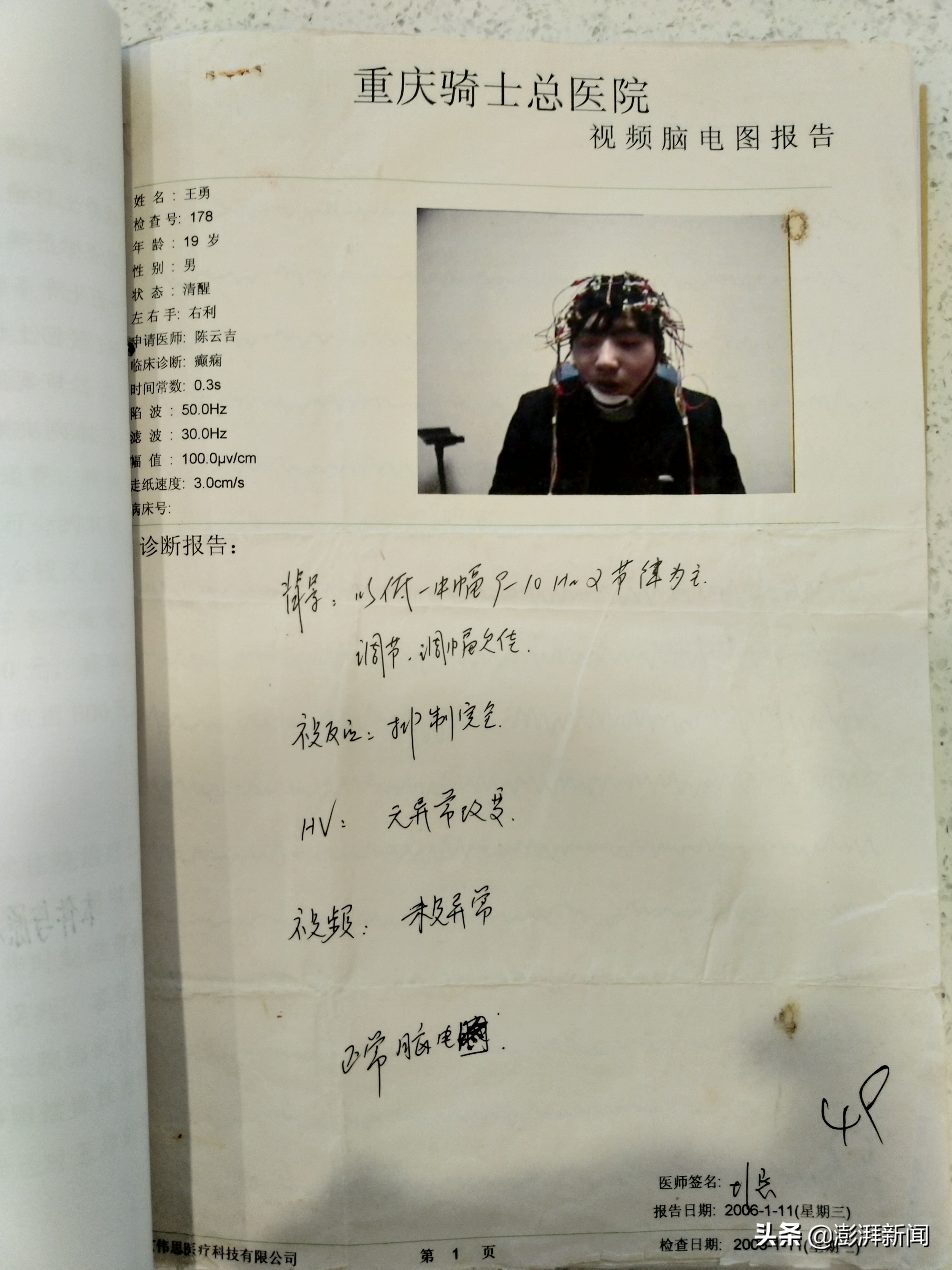 癫痫患者突然去世,癫痫48岁发作死亡