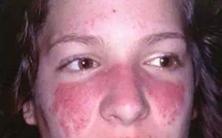 “东方美女”也是病？严重能夺命