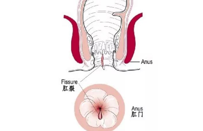 肛裂反复发作必须手术吗,肛裂反复不想手术