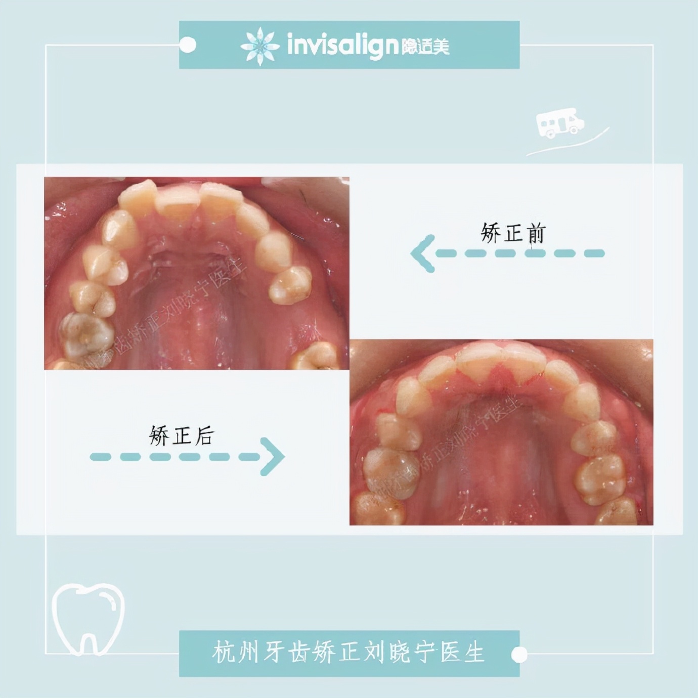 杭州牙齿矫正丨露龈笑怎么办？全面告别露龈笑的4大方法