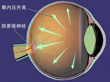 头痛伴随眼压升高怎么回事,头痛恶心想吐是不是青光眼