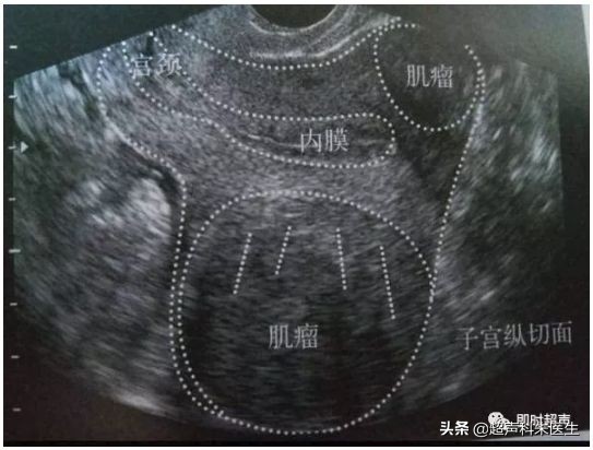 妇科常见疾病的超声诊断视频,超声常见疾病