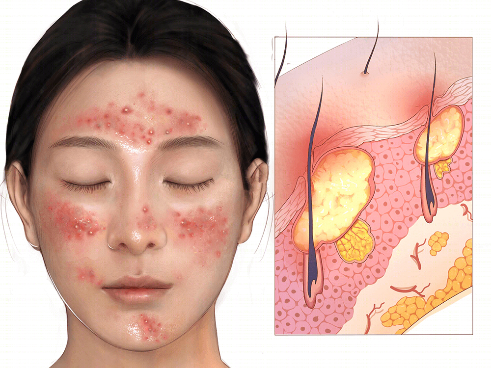 闭口红痘痘反反复复,痘痘闭口多用什么药好得快