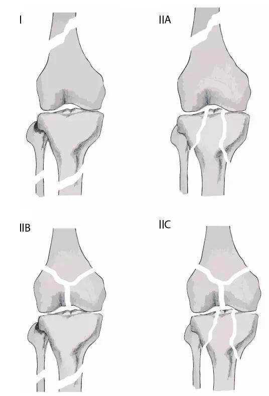 特殊骨折类型,特殊骨折体征