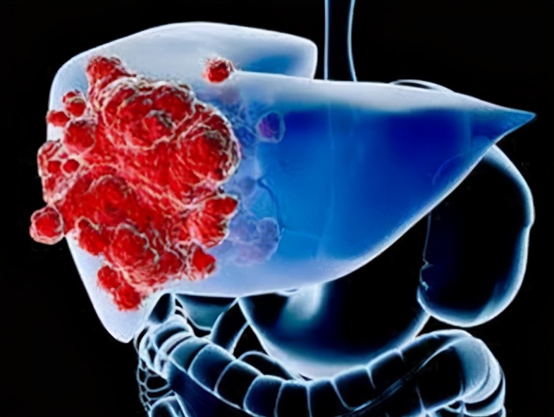 得了肝癌全身痛浑身无力吗,肝癌的症状胸后背疼痛警惕四种病