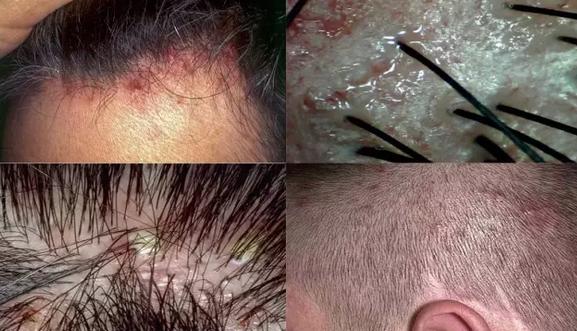 螨虫、出油、头皮干燥,到底是什么让你秃然成熟?