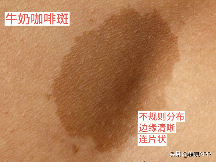 脸上有斑怎么祛斑最快最有效,脸上长斑点用什么药才能祛斑