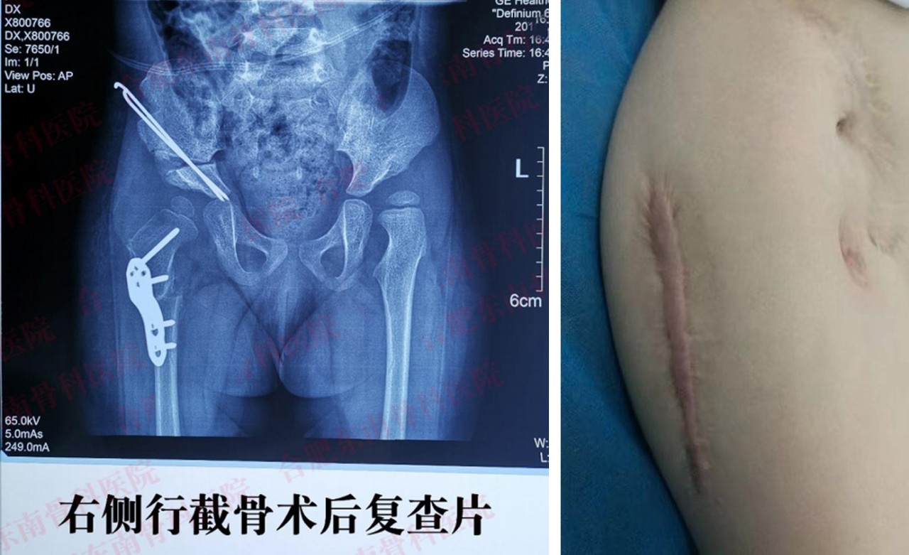 髋关节脱位宝宝保守治疗是怎样的,髋关节脱位宝宝护理