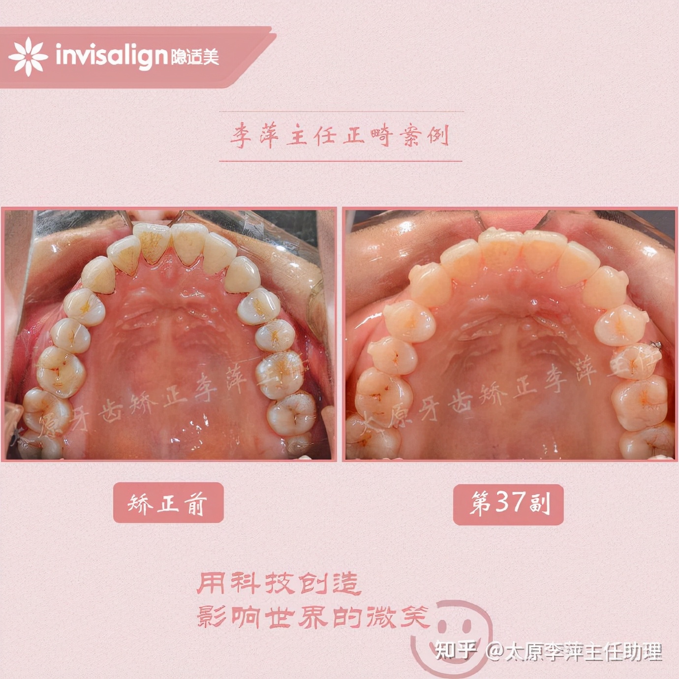 太原牙齿矫正靠谱吗,太原成人隐形牙套牙齿不齐