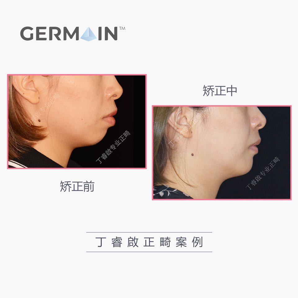 郑州牙齿矫正丁睿啟|下巴后缩病例合集