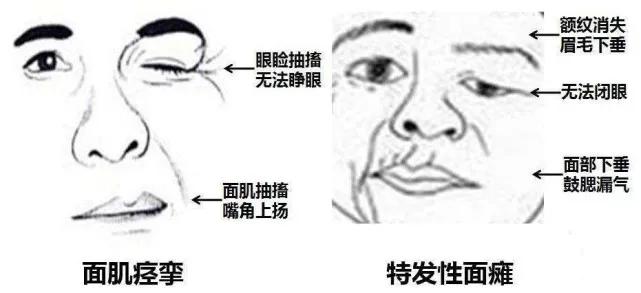 面肌痉挛手术费用成功率是多少,面肌痉挛久治不愈的危害有哪些