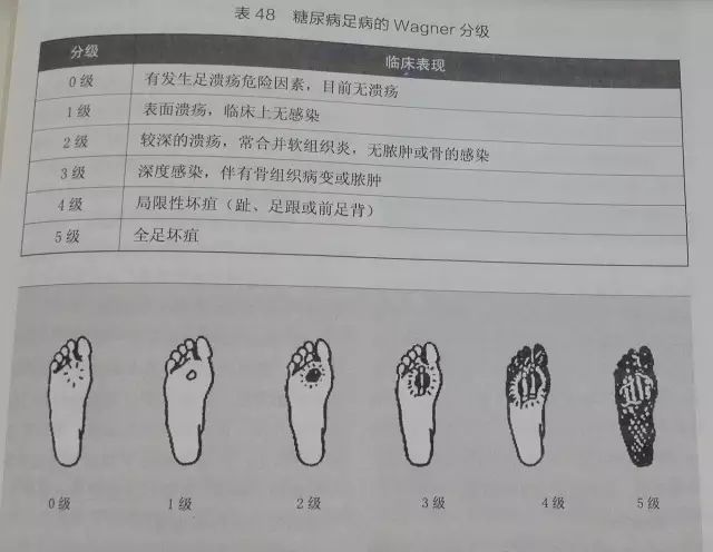 糖尿病足脚趾黑了必须截肢吗,糖尿病足有什么办法可以避免截肢
