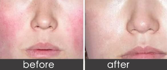 郭鸿财：皮肤薄一直泛红，对于这样的*血丝红**皮肤该如何保养呢？