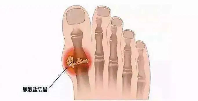 关节一热就刺痛,关节突然发热疼痛