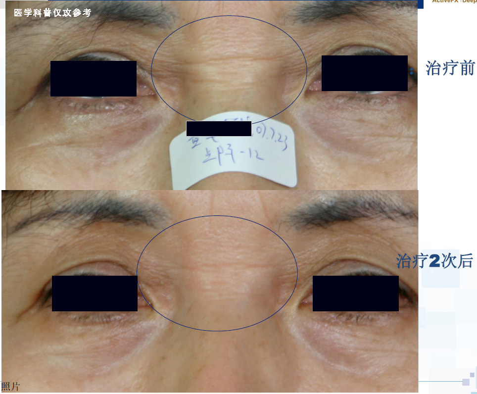 点阵激光的终极效果,超脉冲co2点阵激光效果好吗