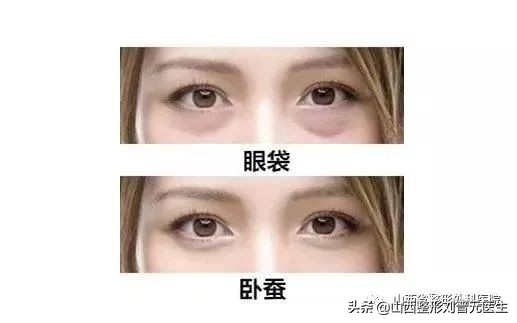 46岁做眼袋还需要做卧蚕吗,现在都把眼袋叫卧蚕了吗