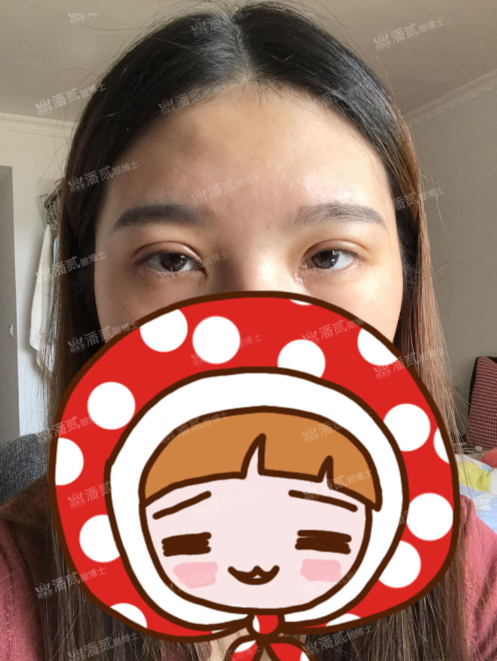 原来双眼皮不好看有必要继续割吗,割双眼皮是不是越修复越难看