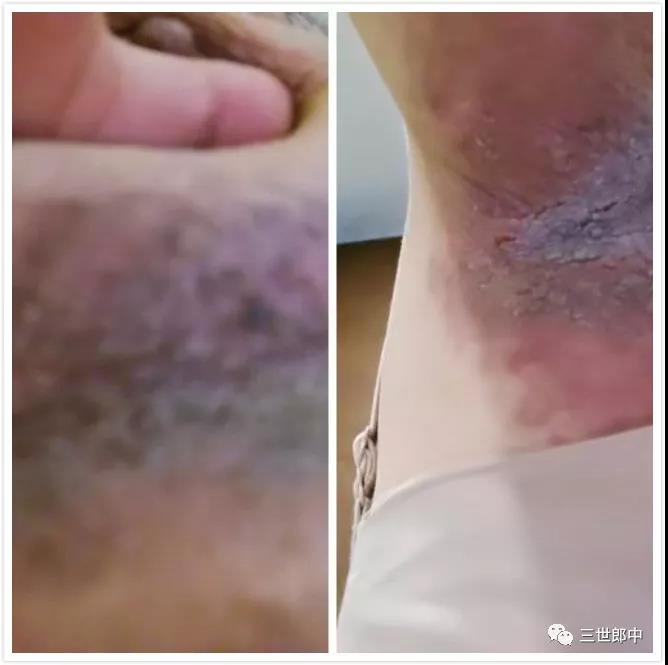 乳房等部位皮肤渗液案