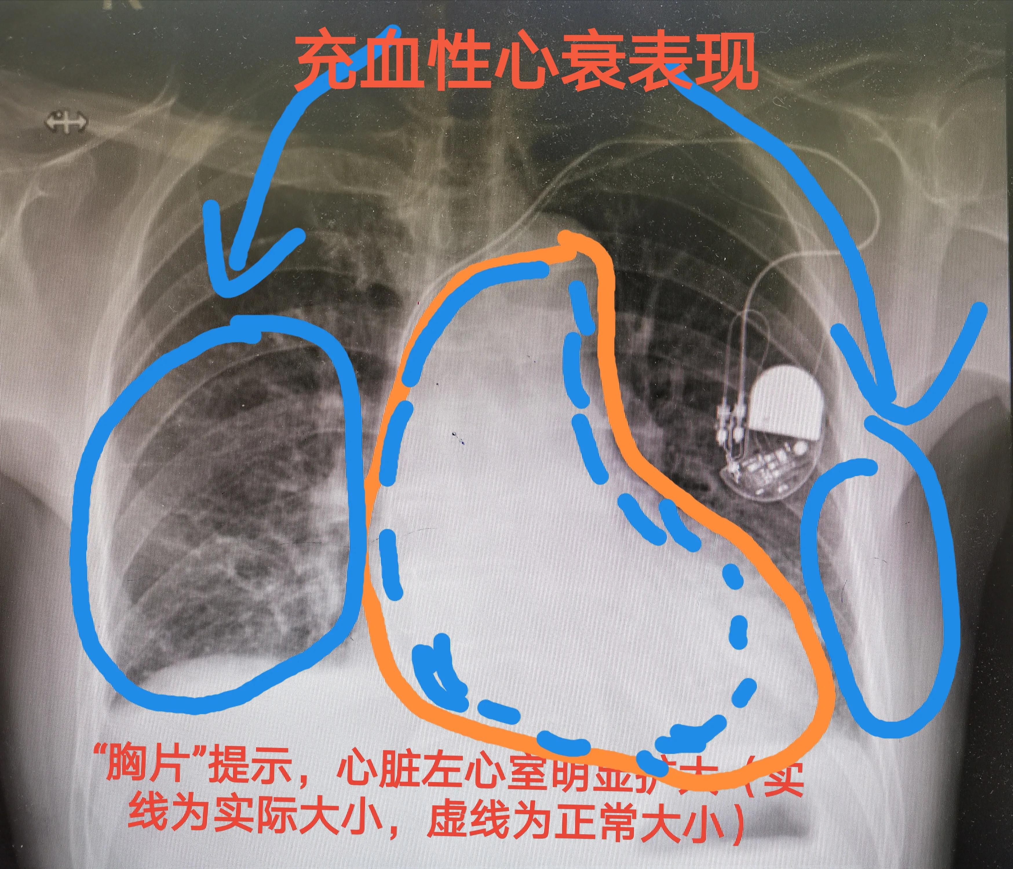88岁老人心跳过快需要装起搏器吗,老人胸闷气短找中医看可以吗