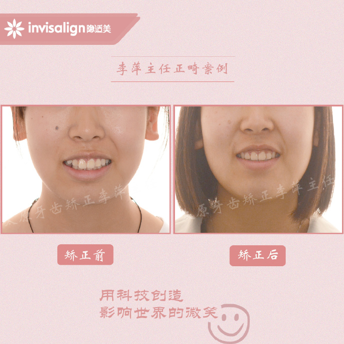 深覆合牙齿矫正不拔牙打骨钉,太原矫正牙齿需要做正颌吗