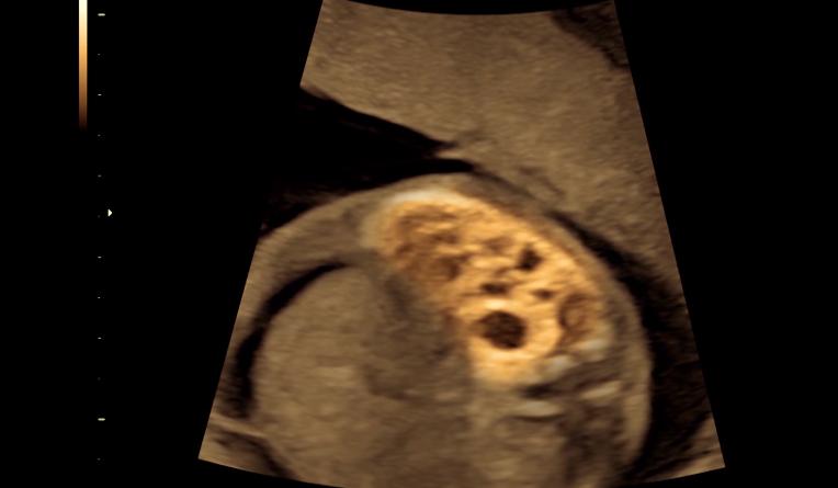 腹中胎儿长出肿瘤，孕妇忍着剧痛，给胎儿打麻药做手术