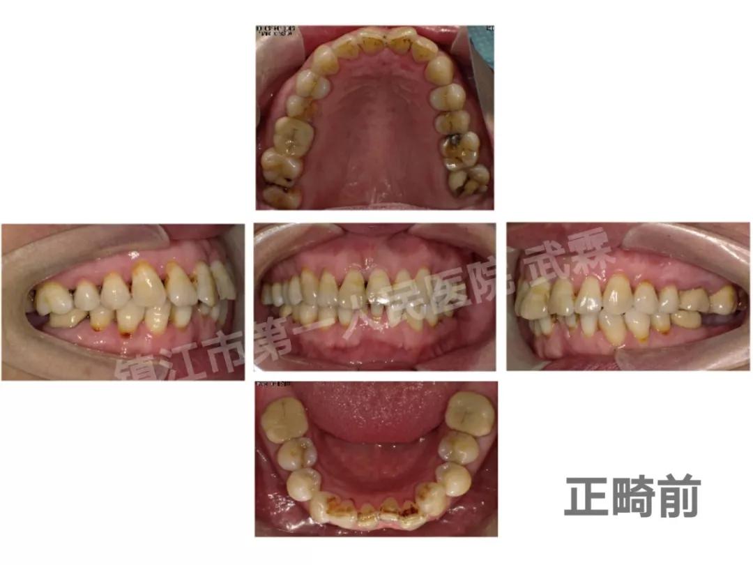 你与颜值和健康之间只差一个牙套,你与颜值巅峰只差一个发际线