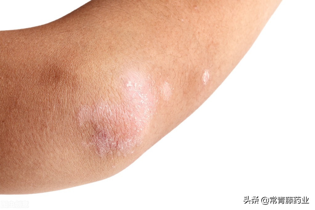 银屑病是怎么产生的？和头皮屑有区别吗？医生告诉你真相