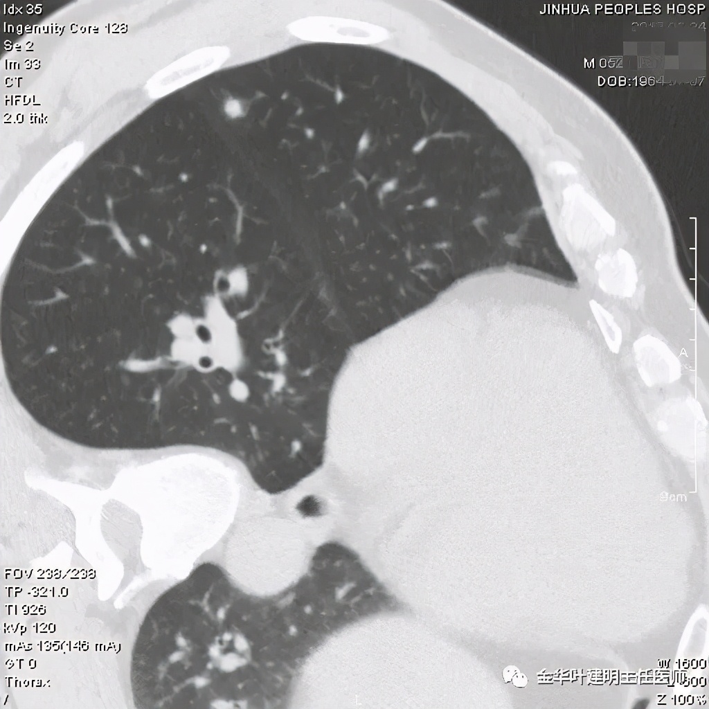叶建明谈肺结节:一招分辨隐球菌性肉芽肿与肺癌