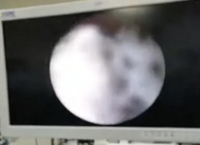 孩子停止发育一直流血,两个多月女婴下阴出血是怎么回事