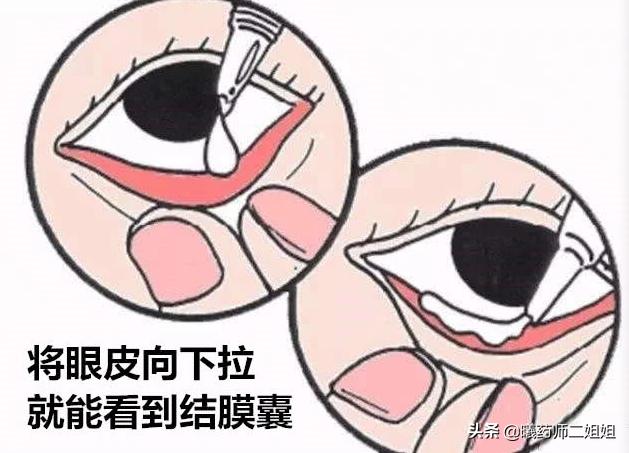 滴眼液的好方法,滴眼液方法正确的是