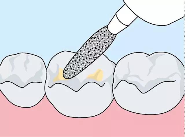 什么是儿童窝沟封闭?会不会痛?1分钟视频带你看懂#雅悦齿科#