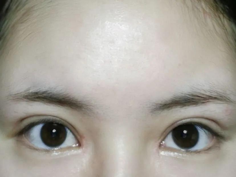 为什么做完双眼皮需要冰敷和热敷,全切双眼皮手术后肉条还是肿