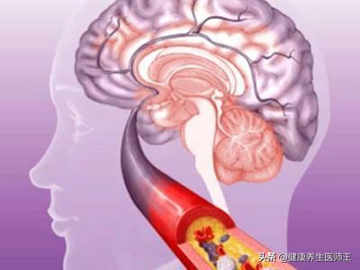 生命健康有哪些方面,临床症状脑血栓形成