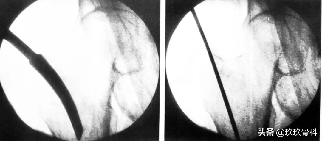 骨科用髓内钉什么材料,骨科髓内钉的作用